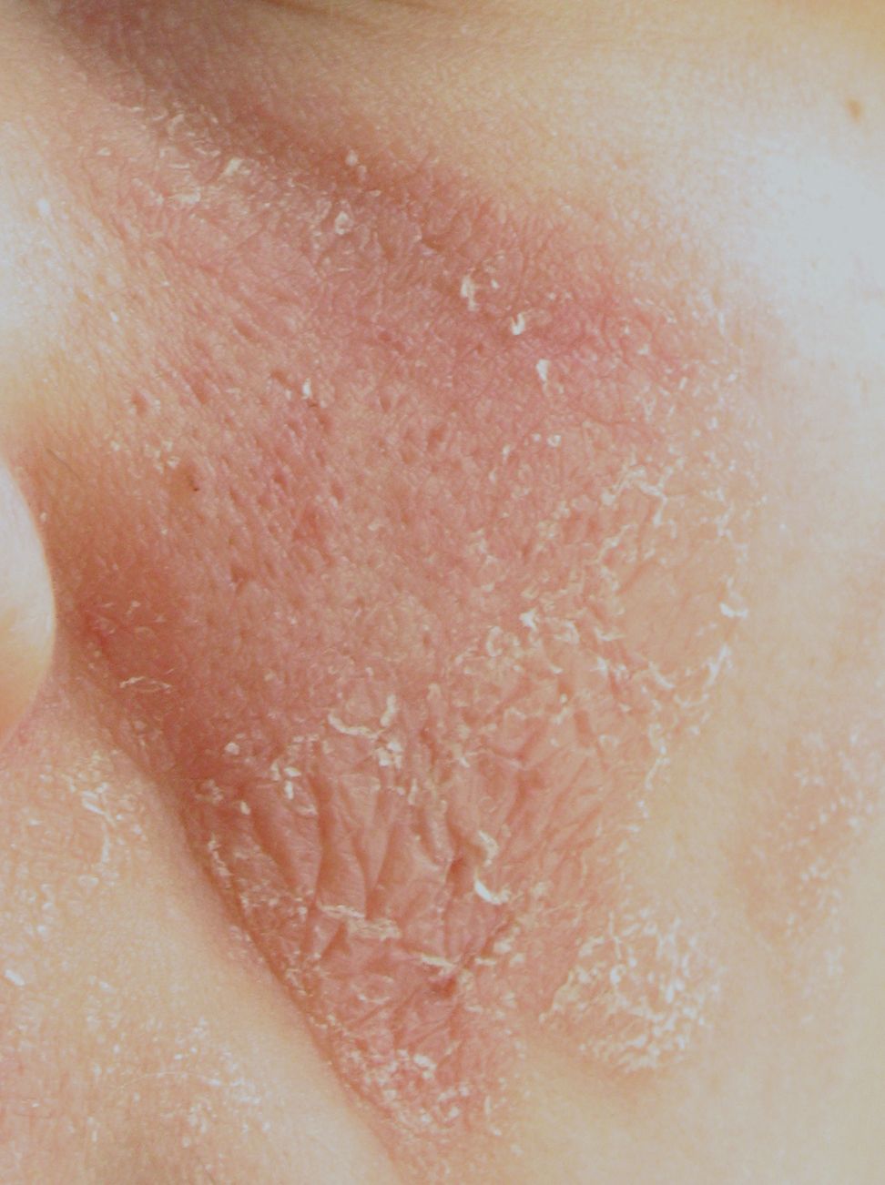 can antibiotics cause skin rash